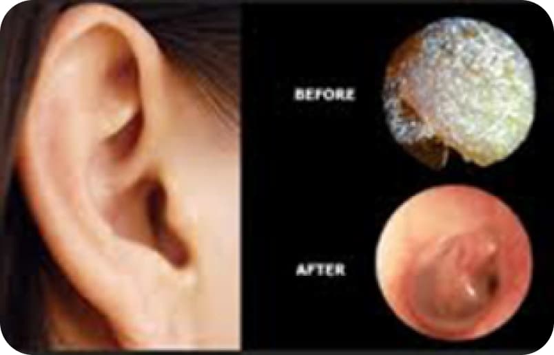 Before and after image of an ear canal